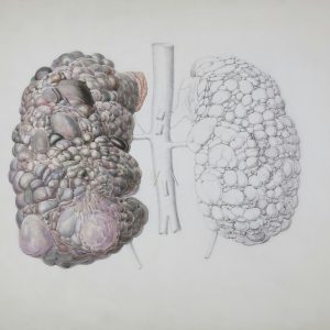 Liver + Kidney